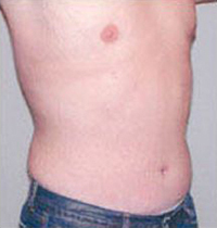 Liposuction Before and After Pictures Houston, TX