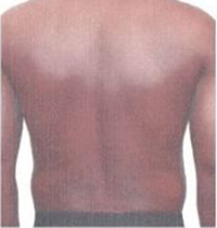 Liposuction Before and After Pictures Houston, TX