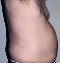 Liposuction Before and After Pictures Houston, TX