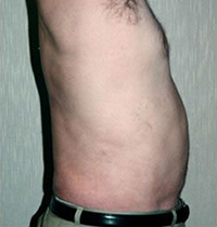 Liposuction Before and After Pictures Houston, TX