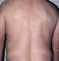 Liposuction Before and After Pictures Houston, TX