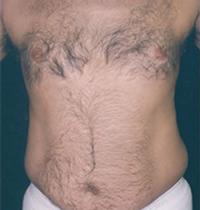 Liposuction Before and After Pictures Houston, TX