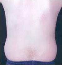 Liposuction Before and After Pictures Houston, TX