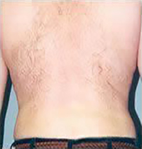 Liposuction Before and After Pictures Houston, TX