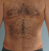 Liposuction Before and After Pictures Houston, TX