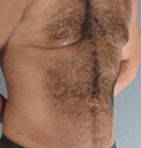 Liposuction Before and After Pictures Houston, TX