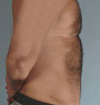 Liposuction Before and After Pictures Houston, TX