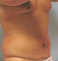 Liposuction Before and After Pictures Houston, TX