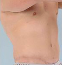 Liposuction Before and After Pictures Houston, TX