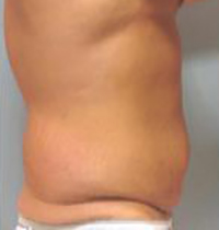 Liposuction Before and After Pictures Houston, TX