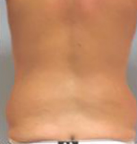 Liposuction Before and After Pictures Houston, TX