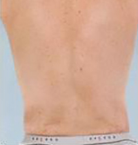 Liposuction Before and After Pictures Houston, TX