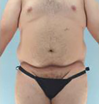 Liposuction Before and After Pictures Houston, TX