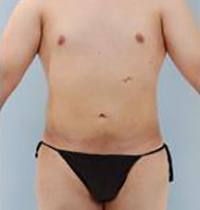 Liposuction Before and After Pictures Houston, TX