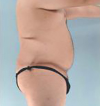 Liposuction Before and After Pictures Houston, TX