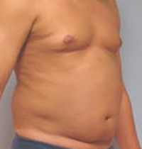 Liposuction Before and After Pictures Houston, TX