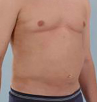 Liposuction Before and After Pictures Houston, TX