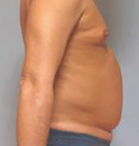 Liposuction Before and After Pictures Houston, TX