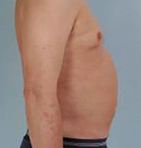 Liposuction Before and After Pictures Houston, TX