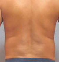 Liposuction Before and After Pictures Houston, TX