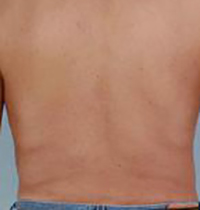 Liposuction Before and After Pictures Houston, TX