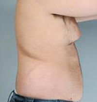 Liposuction Before and After Pictures Houston, TX