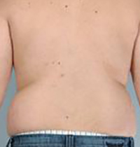 Liposuction Before and After Pictures Houston, TX
