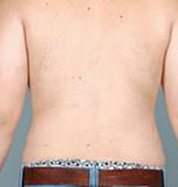 Liposuction Before and After Pictures Houston, TX