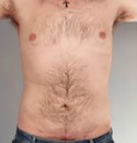 Liposuction Before and After Pictures Houston, TX