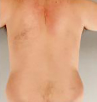 Liposuction Before and After Pictures Houston, TX