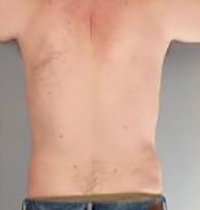 Liposuction Before and After Pictures Houston, TX