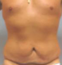 Tummy Tuck Before and After Pictures Houston, TX