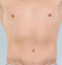 Tummy Tuck Before and After Pictures Houston, TX