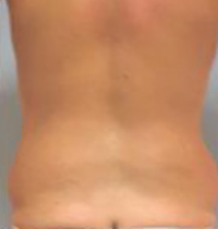 Tummy Tuck Before and After Pictures Houston, TX