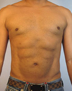 Abdominal Etching Before and After Pictures Houston, TX