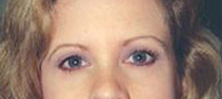 Blepharoplasty Before and After Pictures Houston, TX