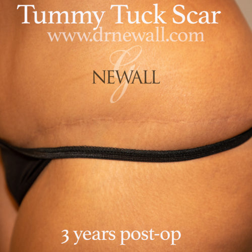 Tummy Tuck in Houston, TX