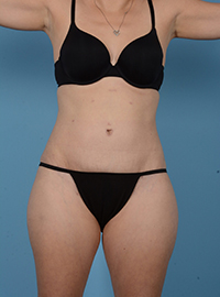 Tummy Tuck Before and After Pictures in Houston, TX