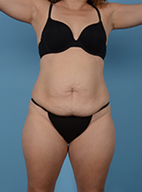 Tummy Tuck Before and After Pictures in Houston, TX
