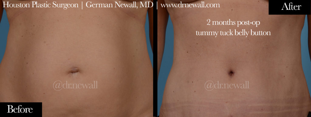 Tummy Tuck Before and After Pictures Houston, TX