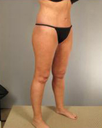 Thighplasty Before and After Pictures Houston, TX