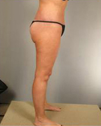 Thighplasty Before and After Pictures Houston, TX