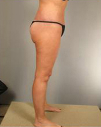 Thighplasty Before and After Pictures Houston, TX