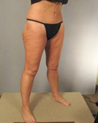 Thighplasty Before and After Pictures Houston, TX