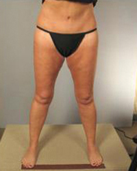 Thighplasty Before and After Pictures Houston, TX