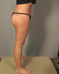 Thighplasty Before and After Pictures Houston, TX