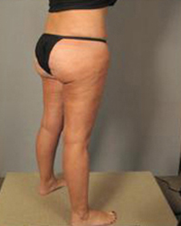 Thighplasty Before and After Pictures Houston, TX