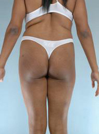 Brazilian Butt Lift Before and After Pictures Houston, TX