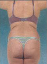 Brazilian Butt Lift Before and After Pictures Houston, TX