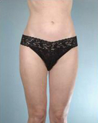 Liposuction Before and After Pictures Houston, TX